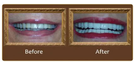 implants_greenacres dentures_greenacres